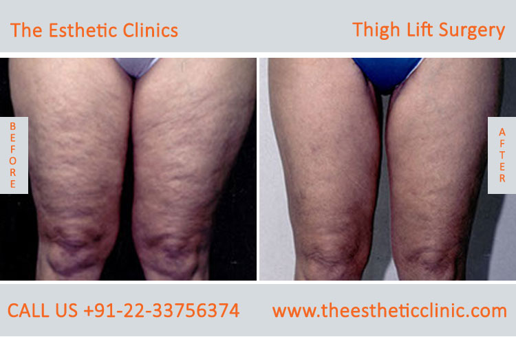 Thigh Lift Surgery, Thigh Reduction before after photos in mumbai india (1)
